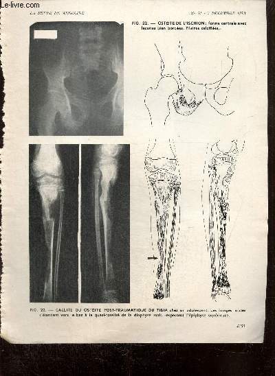 Lot d'articles mdicaux sur les pathologies du bassin et des membres : Fractures de jambe / Fractures du col fmoral / Coxalgie / Fractures du bassin / Fracture du cou de pied / Anvrismes artrio-veineux /...